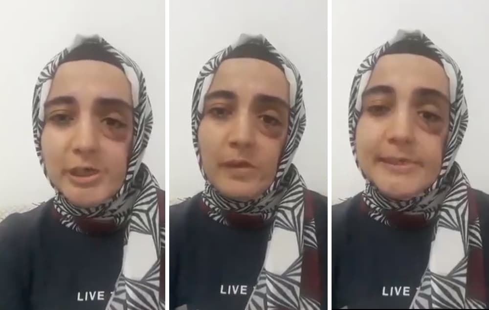 Ayşe Özdoğan’ın durumu kötüye gidiyor, yüzündeki platin yeniden çıkartılacak