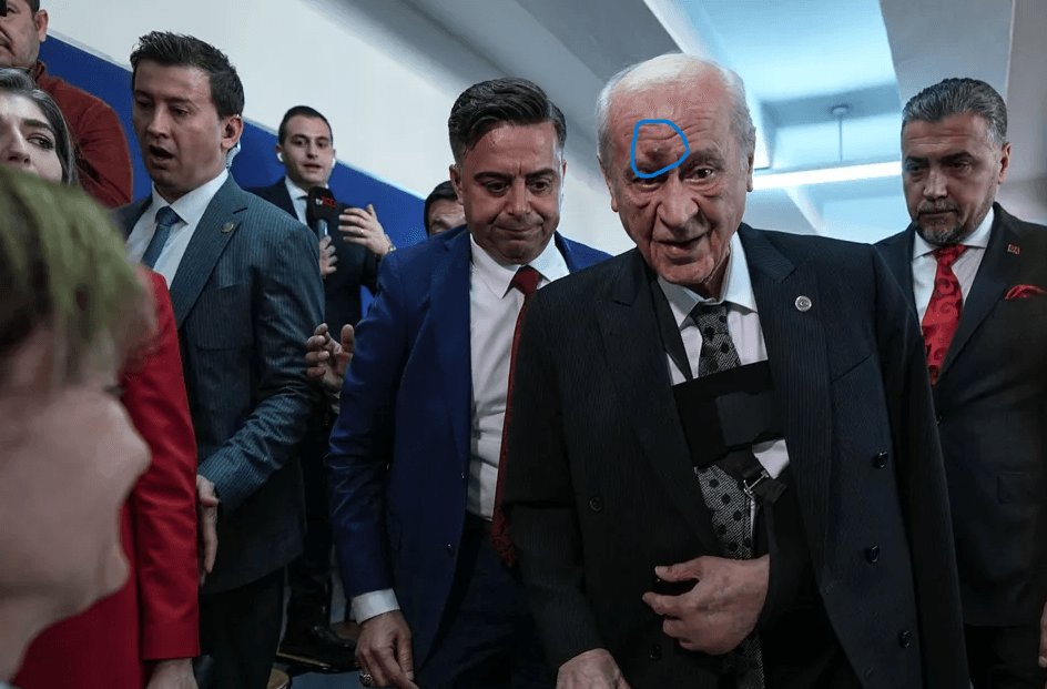 Günler sonra oy kullanmak için ortaya çıkan Bahçeli’nin yüzündeki morluklar dikkat çekti