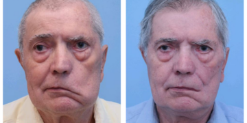 Her 19 dakikada bir kişi, felç geçiriyor: Evsizlik sorunu ise; ruh sağlığını bozuyor