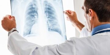 Kanser vakalarında,dünya çapında büyük artış: Son 30 yılda yüzde 80’e yakın artış var