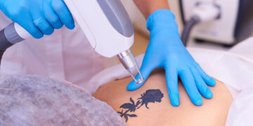 Avustralya, ABD ve Kanada’da 5 yılda 1 milyondan fazla dövme sildirme yapıldı