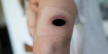 Melbourne’de, et yiyen bakteri alarmı